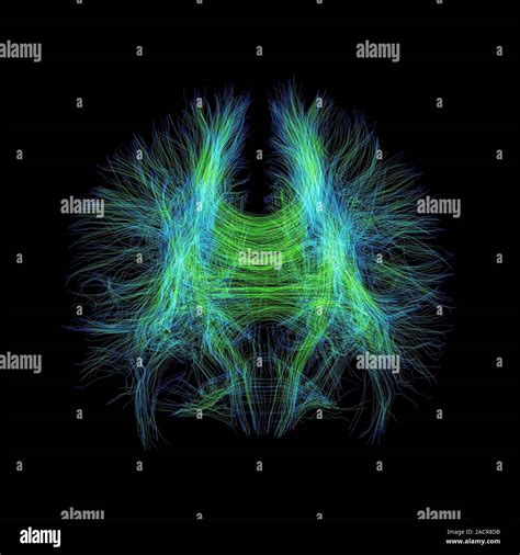 Les Fibres Du Cerveau D L Imagerie Du Tenseur De Diffusion Dti