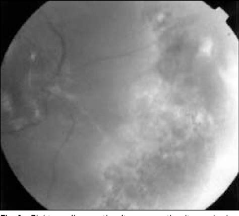 Figure 2 From Herpes Simplex Virus Type 2 Acute Retinal Necrosis In An