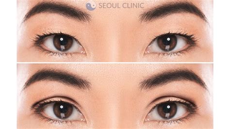 Double Eyelid Surgery Korea Costs Clinics June 2024