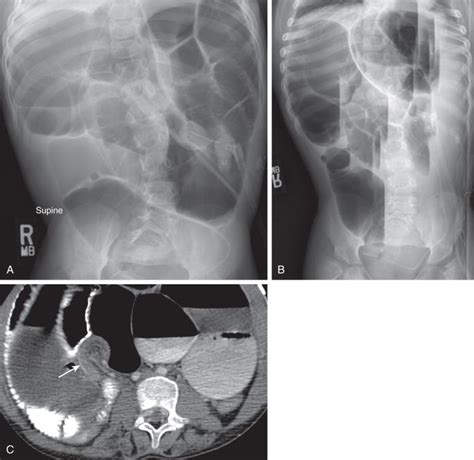 Acquired Lesions Of The Small Intestines Clinical Tree