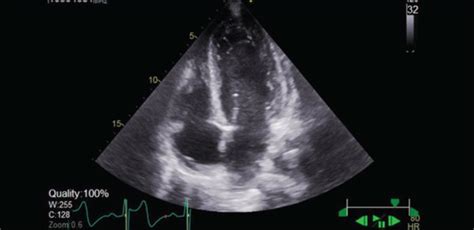 Two Dimensional Transthoracic Echocardiogram Showing Normal Sized