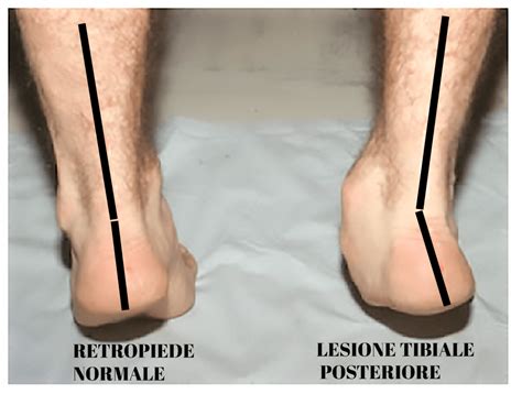 Piede Piatto Dell Adulto Cause E Sintomi Drommi Chirurgia Del Piede