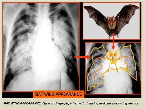 Presentation1.pptx, radiological signs in thoracic radiology.