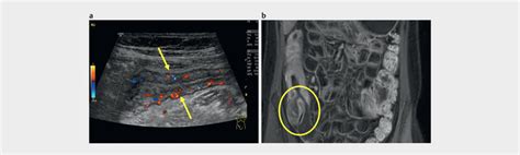 4 9 Year Old Patient With Terminal Ileitis Longitudinal Us Image Of Download Scientific