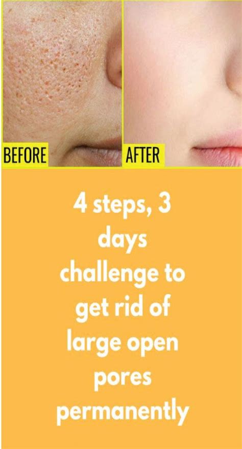 Home Remedy To Get Rid Of Large Open Pores On Face Open Pores On Face