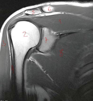 Schaubild Schnittbildanatomie Schulter Cor Quizlet
