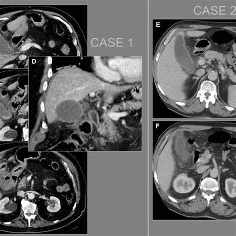 (PDF) Utility of ultrasound-guided percutaneous cholecystostomy in acute cholecystitis treatment ...