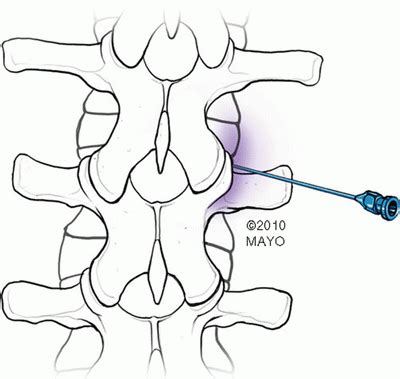 Thoracic and Lumbar Sympathetic Nerve Block and Neurolysis | Radiology Key