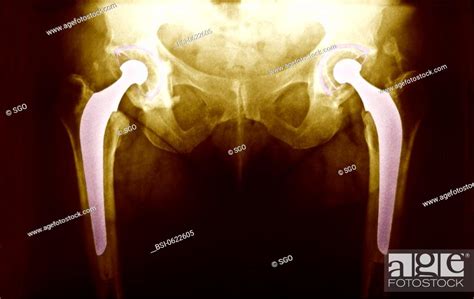 Hip Prosthesis X Ray Total Hip Replacement Frontal X Ray Of Hips