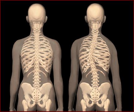 Scoliosis Treatment: What Is Scoliosis? What Causes Scoliosis?