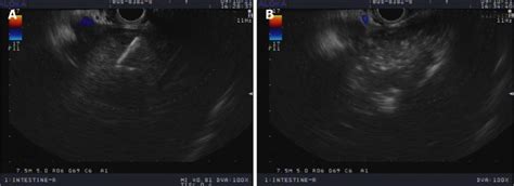 Endoscopic Ultrasound Guided Ethanol Ablation Therapy For Tumors Pmc