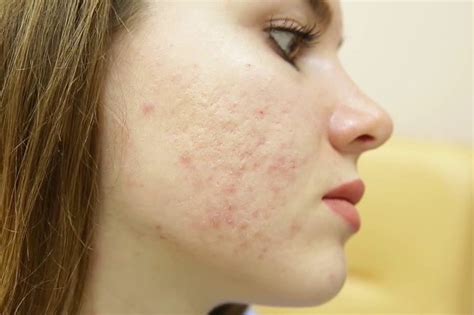 Постакне: как народными средствами убрать последствия прыщей