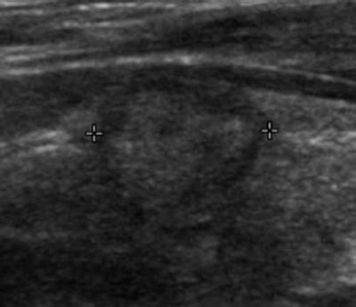 Malignant: Malignant Thyroid Nodules