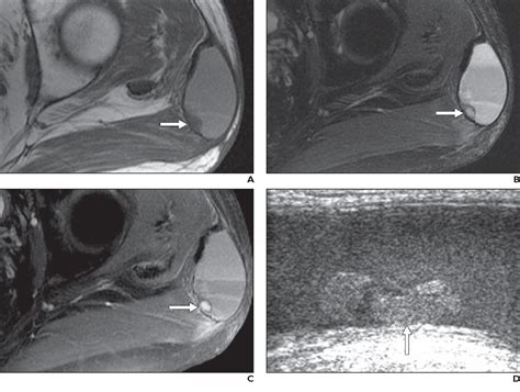 Figure 1—47 From Benign Mural Nodules Within Fluid Collections At Mri