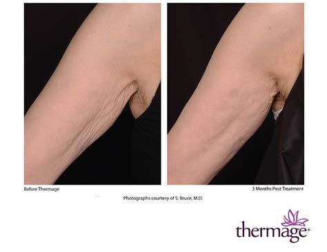 Thermage Skin Tightening Laser Spa Group