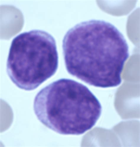 Acute Leukemia Blood Cell Morphology Newsletter 42