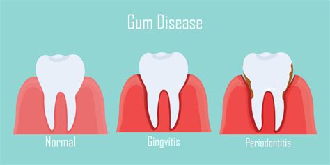 How To Prevent Gingivitis Gentle Dental Maine