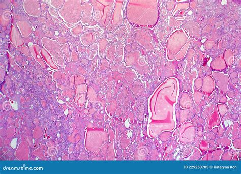 Follicular Adenoma Of Thyroid Gland Royalty-Free Stock Photography ...