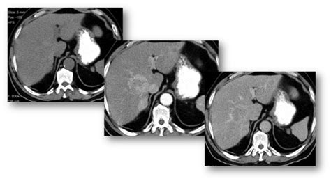 Pancreatic Neuroendocrine Carcinoma Axial T And T Weighted Mr