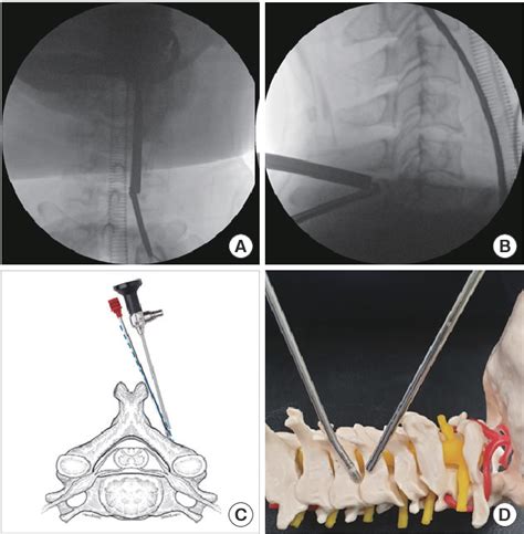 Figure 4 From The Biportal Endoscopic Posterior Cervical Inclinatory