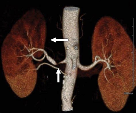 Renovascular Hypertension Bel Air Md And Towson Md Vascular Surgery Associates Llc