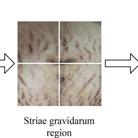 Striae gravidarum photo processing | Download Scientific Diagram