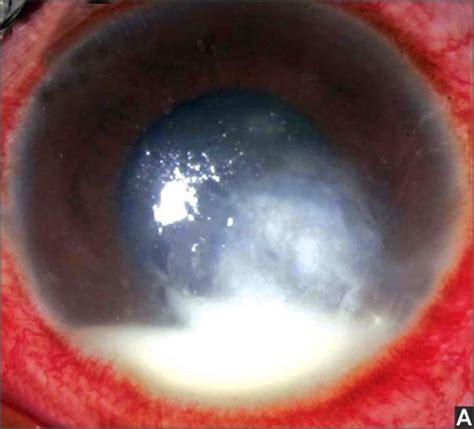 Clinical Presentation Of Fungal Keratitis Tuyenlab