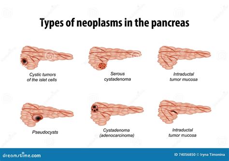 Types Of Neoplasms In The Pancreas. Infographics. Vector Illustration ...