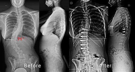 Non Fusion Corrective Scoliosis Surgery Scoliosis And Spine Associates