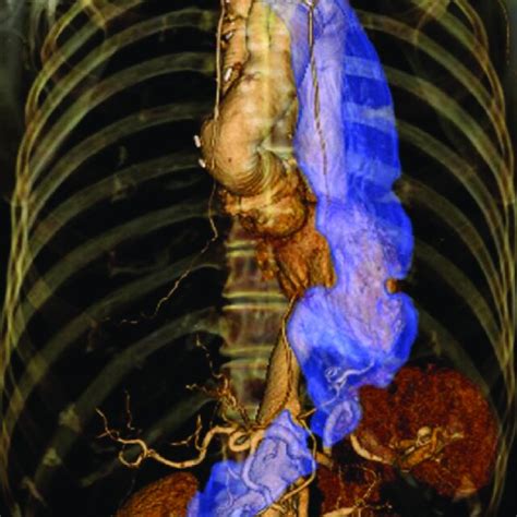 Postoperative Computed Tomography Scan Showing The Gastric Conduit