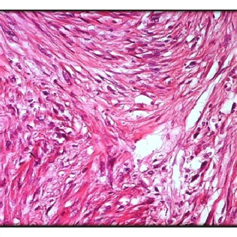 Classical Form Of Soft Tissue Lms Made Of Intersecting Fascicles Of