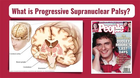 Progressive Supranuclear Palsy Psp And Phantom Pain Youtube