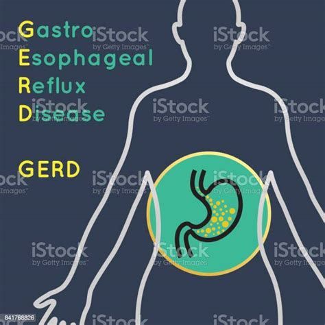 Gastroesophageal Reflux Disease Vector Collection Stock Illustration