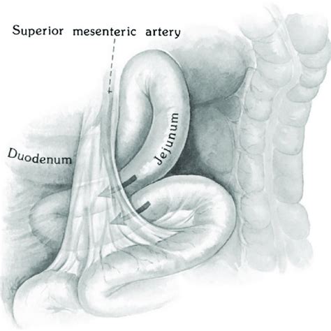 Anatomy of right paraduodenal hernia, showing bowel entering the fossa ...