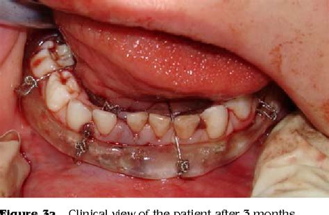 Figure From Splint Fixation With Circummandibular Wires For Pediatric