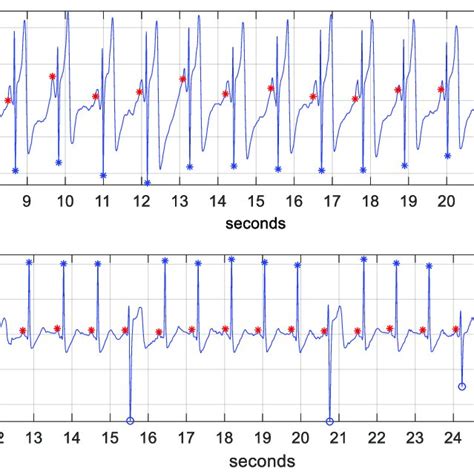 Ecg Strips With Detected Normal Heartbeats Blue Ectopic