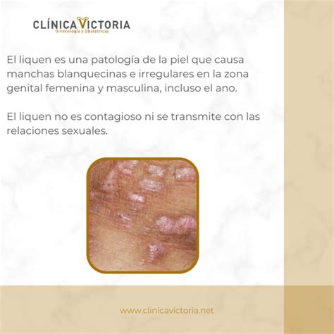 Liquen Escleroso Atr Fico Cl Nica Victoria