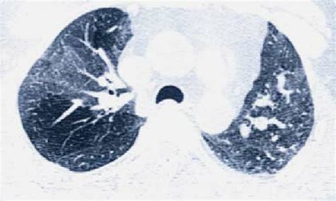 Air Trapping In Chest Hrct In Expiratory Phase In A Mustard Gas Exposed