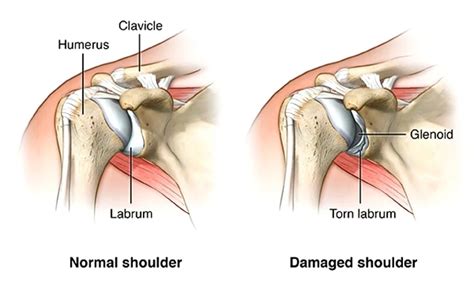 Shoulder Dislocation Symptoms And Treatment