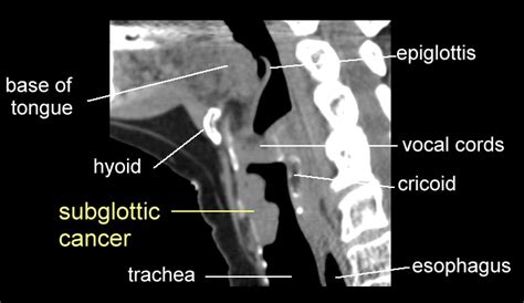 Subglottic Larynx Cancer