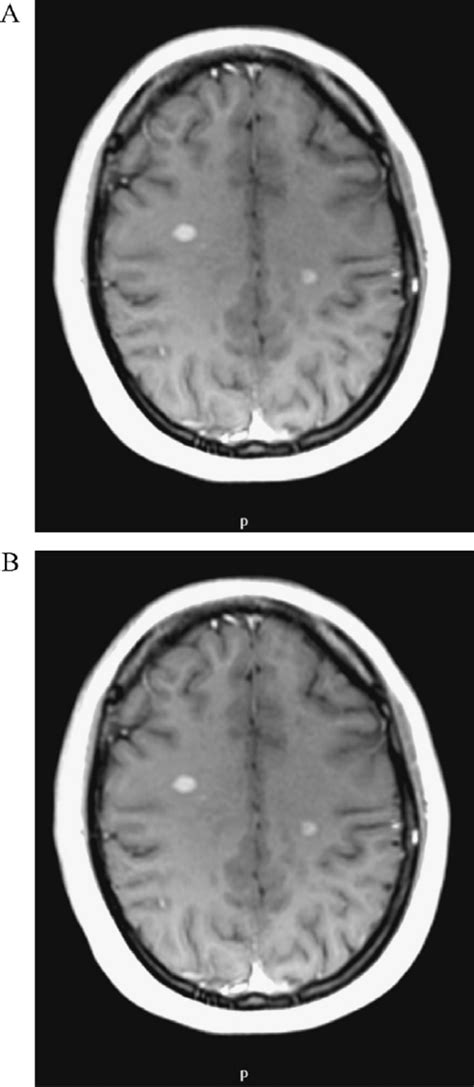 Brain MRI from MS patients: axial T1WI shows two hypointense areas on ...