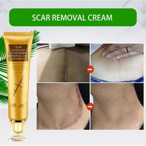 ☸ↂ Scar Remover Cream Scarminator Fixscar Scar Gel Pimple Marks Remover