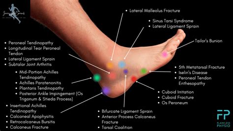 Foot Pain Chart Find The Cause Of Foot Pain With Our Diagram