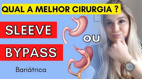 CIRURGIA DA BARIÁTRICA BYPASS OU SLEEVE DIFERENÇAS QUAL A MELHOR