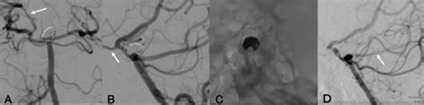 The Post Coiling Angiogram A Is An Antero Posterior View Of The Right