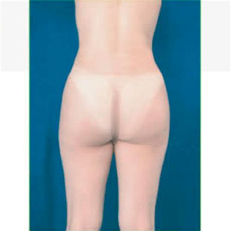 Lipoescultura Antes Y Despu S Dr Francisco Jose Sales