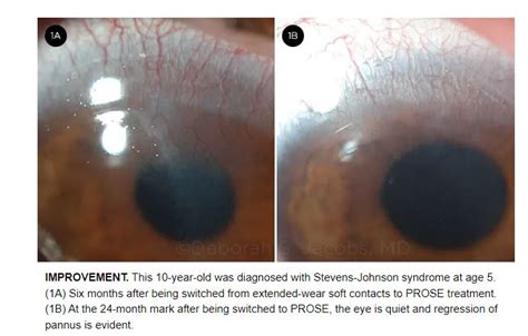 Scleral Lenses Keratoconus Insights