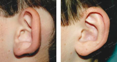 Otoplasty: surgery of the ears - Doctor Louis Benelli in Paris