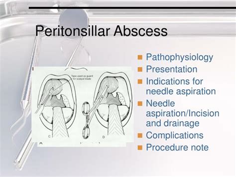 Peritonsillar Abscess Anatomy