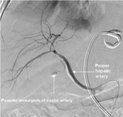 Digital Subtraction Angiography DSA Images Of The Hepatic Artery A